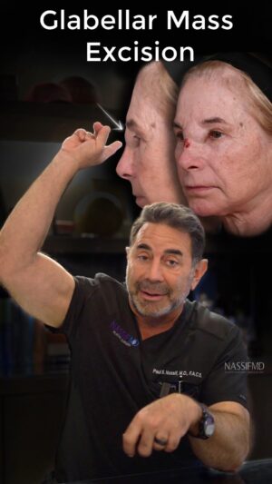 Paul Nassif Instagram - ⚠️ Warning: Do Not Inject Filler Into Your Glabella! 

Not only can it cause skin necrosis, which means the skin dies, but it can even cause blindness or other problems. 

My patient, Linda, developed this big mass, which you can see in the video above. FDA approved filler doesn’t usually cause this type of reaction, so we didn’t exactly know what was going on until we went into the OR. By doing a modified Lynch procedure, where we made incisions on the sides of the nose and dissected out the mass of tissue, we figured out what it was. The tissue ended up being what we call a foreign body reaction. Her body created the mass because it didn’t accept whatever was injected into her face. 

Here are Linda’s results after only 1-month, but they’ll continue to improve as swelling will decrease over the next three to four months! 

If you would like to treat the glabella, @nassifmedical recommends using Botox or a laser treatment instead! 

Trusted with Faces Worldwide®  
_____________________________________________   
☎️☎️ Call us at: 1 (310) 275-2467   
💌💌 Email us at: concierge@drpaulnassif.com 

#nassifmedical #nassifmd #filler #botched #botchedfiller #glabella #facialplasticsurgery #beforeandafter #results #modifiedlynchprocedure 
#plasticsurgeon #cosmeticsurgery #facialplasticsurgery #face #tt #transformationtuesday