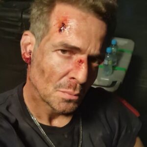 Pêpê Rapazote Instagram - Duro? tu sabes lá o que é ser um duro?
Mataram-me os piolhos, mataram-me os fungos dos pés, mataram-me as lombrigas, até me mataram os piolhos da púbis...
Mas não conseguiram matar-me o...
Herpes?... vêem aqui? Odeio, é horrível... olhem para isto vêem? Odeio...

Duro? Tu no sabes que es un duro
Me mataron los piojos, me mataron los hongos en los pies, me mataron los gusanos, hasta me mataron los piojos de la púbis (ladillas)...
Pero no lograron matarme el...
Herpes?... lo ven aqui? Lo odio, es horrible... miren esto... Lo odio...

#herpes #gusanos #chatos #fungos #pubis #lombrigas #piolhos #piojos #lice #worms #crabs #hateit

NOTA - Também não tenho herpes
NOTA - tampoco tengo herpes
FYI - Ain't got no herpes either