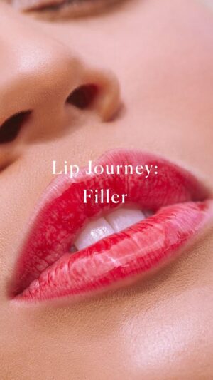 Rachel Brann Instagram - This journey has been a wild one!!🔥 I’ve never had my lips completely dissolved before injecting again, and I must say, I highly recommend this!! It was also nice to see my natural shape and appreciate my body for that short period of time. 😂 but obviously given the choice, I choose a little bit of filler.  So tell me… are yall interested in injections? What is it that keeps you from injecting? Do you have any questions for me? 
#lipfiller #lipinjections #lipjourney