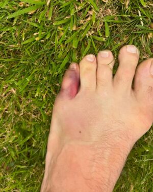 Rafael dos Anjos Instagram - My injury when I pulled out against Conor in 2016 vs his injury. I remember I told Dana and Lorenzo Fertitta  if was able to walk to the octagon I would fight but unfortunately Doctors put me on hard cast for 4 weeks. Let me know what you guys think in the comments below. I Hope i get to meet you one day in the octagon and smash your face.