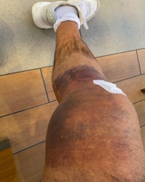 Roberto García Ruiz Instagram - Ya sin vendas…A darle caña para recuperarse. Tiene mal aspecto pero va viento en popa…Nuevo reto por delante. A por el…
#actor @filmstage_spain #lavidaesmaravillosa