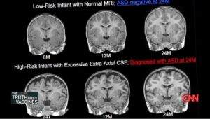 Sanjay Gupta Instagram - Take a look at the brain images here. Evidence of brain changes associated with autism as early as six months of age. Relevance: brain changes start long before we previously realized and before the MMR vaccine is given.