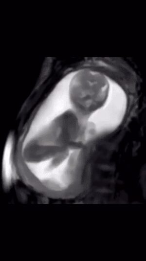 Sherry A. Ross Instagram - Wondering how to make baby move in utero? One of the  ways I think is the most effective way, is to eat or drink something with a moderate natural sugar content. You may notice more fetal movement right after eating a meal when Mom’s sugar or glucose levels are high. The increase in Mom’s blood sugar often increases baby’s alertness and encourages them to move around. Check out more ways in this article from @thebump ! https://www.thebump.com/a/how-to-make-baby-move