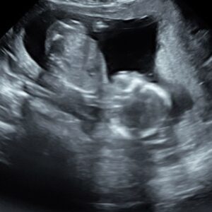 Sigurbjörg Alma Ingólfsdóttir Instagram - February ✨ filming and finding out we are having a little baby boy 👶🏼💙🥰