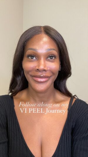 Stasha Sanchez Instagram - Reveal your 𝐫𝐚𝐝𝐢𝐚𝐧𝐭 glow with the transformative magic of our 𝐕𝐈 𝐂𝐡𝐞𝐦𝐢𝐜𝐚𝐥 𝐏𝐞𝐞𝐥! ✨ 

Say goodbye to dull skin and hello to a brighter, smoother you. 🌟 

Ready to glow? Schedule your 𝐕𝐈 𝐂𝐡𝐞𝐦𝐢𝐜𝐚𝐥 𝐏𝐞𝐞𝐥 today and embark on a journey to revitalized, beautiful skin! ✨ 

👱🏻‍♀️ 𝐁𝐫𝐢𝐭𝐭𝐚𝐧𝐲 𝐒𝐮𝐜𝐡𝐚𝐧𝐞𝐤 𝐍𝐏-𝐂, 𝐀𝐏𝐑𝐍 
📲 @theblonde.injector
💉 𝖡𝗈𝗍𝗈𝗑 | 𝖥𝗂𝗅𝗅𝖾𝗋 | 𝖲𝖼𝗎𝗅𝗉𝗍𝗋𝖺 | 𝖪𝗒𝖻𝖾𝗅𝗅𝖺 | 𝖯𝖱𝖯 | 𝖯𝖣𝖮 𝖳𝗁𝗋𝖾𝖺𝖽𝗌 | 𝖲𝗒𝗅𝖿𝗂𝗋𝗆 𝖱𝖥 𝖬𝗂𝖼𝗋𝗈𝗇𝖾𝖾𝖽𝗅𝗂𝗇𝗀 | 𝖲𝗄𝗂𝗇𝖼𝖺𝗋𝖾
📍Atlanta, GA @cultclinics
💬Text 205•537•0829 to book