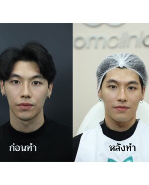 Suphakorn Sriphothong Instagram - มาให้พี่หมอดูแลหน้าให้ก่อนเที่ยวปีใหม่ พี่หมอเลยให้ลอง Hi-Fusion ยกกระชับรูปหน้า ไม่ต้องรอทำเสร็จเห็นผลเลยครับ 🫶🏻🫶🏻🫶🏻