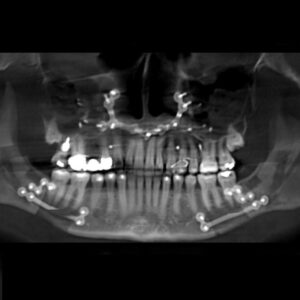 Tabitha Soren Instagram - Today marks six months post-double-jaw surgery for sleep problems. Not for the faint of heart.⁠
⁠