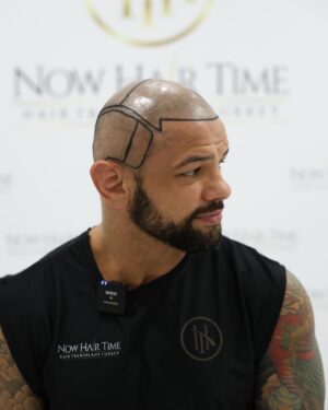 Thiago Alves Instagram - Last week, I traveled to Istanbul, Turkey, to get a hair transplant with my friends @now.hairtime. Before making the decision, I did a lot of research, and I am incredibly pleased with the experience.

The entire process was seamless. From pick-up to drop-off, the professionals at @now.hairtime went above and beyond my expectations. The transplant took about 8 hours and besides the anesthesia, it was completely painless.

Many people had told me that I looked good bald, but I wanted the option to have hair again. So, why not?

If you are considering getting a hair transplant, I highly recommend taking the trip and visiting my friends at @now.hairtime. Don't forget to mention the Pitbull sent you - you won't regret it.

Oss 

🇧🇷🇧🇷🇧🇷🇧🇷

Na semana passada, viajei para Istambul, na Turquia, para fazer um transplante capilar com meus amigos @now.hairtime. Antes de tomar a decisão, pesquisei bastante e estou extremamente satisfeito com a experiência.

Todo o processo foi perfeito. Da chegado até a saída, os profissionais da @now.hairtime superaram minhas expectativas. O transplante durou cerca de 8 horas e tirando a a anestesia foi totalmente indolor.

Muitas pessoas me disseram que eu parecia bem careca, mas eu queria a opção de ter cabelo novamente. Então por que não?

Se você está pensando em fazer um transplante capilar, recomendo fortemente que você faça uma viagem e visite meus amigos em @now.hairtime. Não se esqueça de mencionar o Pitbull que lhe enviou - você não se arrependerá.

#longhairdontcare #Pitbull #CoachPitbull #yourfavoritemmacoach #worldchampion #muaythaiwreckingmachine #itrainanywhere #livetrained #attarmy #mma #ufc #bellator #pfl #muaythai #wrestling #boxing #bjj #autismdad #autismawareness #wontstopuntiliwin #guns #livingthedream