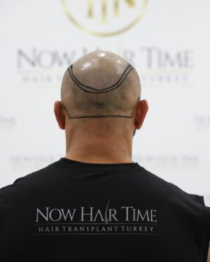 Thiago Alves Instagram - Last week, I traveled to Istanbul, Turkey, to get a hair transplant with my friends @now.hairtime. Before making the decision, I did a lot of research, and I am incredibly pleased with the experience.

The entire process was seamless. From pick-up to drop-off, the professionals at @now.hairtime went above and beyond my expectations. The transplant took about 8 hours and besides the anesthesia, it was completely painless.

Many people had told me that I looked good bald, but I wanted the option to have hair again. So, why not?

If you are considering getting a hair transplant, I highly recommend taking the trip and visiting my friends at @now.hairtime. Don't forget to mention the Pitbull sent you - you won't regret it.

Oss 

🇧🇷🇧🇷🇧🇷🇧🇷

Na semana passada, viajei para Istambul, na Turquia, para fazer um transplante capilar com meus amigos @now.hairtime. Antes de tomar a decisão, pesquisei bastante e estou extremamente satisfeito com a experiência.

Todo o processo foi perfeito. Da chegado até a saída, os profissionais da @now.hairtime superaram minhas expectativas. O transplante durou cerca de 8 horas e tirando a a anestesia foi totalmente indolor.

Muitas pessoas me disseram que eu parecia bem careca, mas eu queria a opção de ter cabelo novamente. Então por que não?

Se você está pensando em fazer um transplante capilar, recomendo fortemente que você faça uma viagem e visite meus amigos em @now.hairtime. Não se esqueça de mencionar o Pitbull que lhe enviou - você não se arrependerá.

#longhairdontcare #Pitbull #CoachPitbull #yourfavoritemmacoach #worldchampion #muaythaiwreckingmachine #itrainanywhere #livetrained #attarmy #mma #ufc #bellator #pfl #muaythai #wrestling #boxing #bjj #autismdad #autismawareness #wontstopuntiliwin #guns #livingthedream