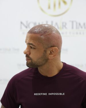Thiago Alves Instagram - Last week, I traveled to Istanbul, Turkey, to get a hair transplant with my friends @now.hairtime. Before making the decision, I did a lot of research, and I am incredibly pleased with the experience.

The entire process was seamless. From pick-up to drop-off, the professionals at @now.hairtime went above and beyond my expectations. The transplant took about 8 hours and besides the anesthesia, it was completely painless.

Many people had told me that I looked good bald, but I wanted the option to have hair again. So, why not?

If you are considering getting a hair transplant, I highly recommend taking the trip and visiting my friends at @now.hairtime. Don't forget to mention the Pitbull sent you - you won't regret it.

Oss 

🇧🇷🇧🇷🇧🇷🇧🇷

Na semana passada, viajei para Istambul, na Turquia, para fazer um transplante capilar com meus amigos @now.hairtime. Antes de tomar a decisão, pesquisei bastante e estou extremamente satisfeito com a experiência.

Todo o processo foi perfeito. Da chegado até a saída, os profissionais da @now.hairtime superaram minhas expectativas. O transplante durou cerca de 8 horas e tirando a a anestesia foi totalmente indolor.

Muitas pessoas me disseram que eu parecia bem careca, mas eu queria a opção de ter cabelo novamente. Então por que não?

Se você está pensando em fazer um transplante capilar, recomendo fortemente que você faça uma viagem e visite meus amigos em @now.hairtime. Não se esqueça de mencionar o Pitbull que lhe enviou - você não se arrependerá.

#longhairdontcare #Pitbull #CoachPitbull #yourfavoritemmacoach #worldchampion #muaythaiwreckingmachine #itrainanywhere #livetrained #attarmy #mma #ufc #bellator #pfl #muaythai #wrestling #boxing #bjj #autismdad #autismawareness #wontstopuntiliwin #guns #livingthedream