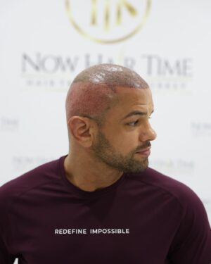 Thiago Alves Instagram - Last week, I traveled to Istanbul, Turkey, to get a hair transplant with my friends @now.hairtime. Before making the decision, I did a lot of research, and I am incredibly pleased with the experience.

The entire process was seamless. From pick-up to drop-off, the professionals at @now.hairtime went above and beyond my expectations. The transplant took about 8 hours and besides the anesthesia, it was completely painless.

Many people had told me that I looked good bald, but I wanted the option to have hair again. So, why not?

If you are considering getting a hair transplant, I highly recommend taking the trip and visiting my friends at @now.hairtime. Don't forget to mention the Pitbull sent you - you won't regret it.

Oss 

🇧🇷🇧🇷🇧🇷🇧🇷

Na semana passada, viajei para Istambul, na Turquia, para fazer um transplante capilar com meus amigos @now.hairtime. Antes de tomar a decisão, pesquisei bastante e estou extremamente satisfeito com a experiência.

Todo o processo foi perfeito. Da chegado até a saída, os profissionais da @now.hairtime superaram minhas expectativas. O transplante durou cerca de 8 horas e tirando a a anestesia foi totalmente indolor.

Muitas pessoas me disseram que eu parecia bem careca, mas eu queria a opção de ter cabelo novamente. Então por que não?

Se você está pensando em fazer um transplante capilar, recomendo fortemente que você faça uma viagem e visite meus amigos em @now.hairtime. Não se esqueça de mencionar o Pitbull que lhe enviou - você não se arrependerá.

#longhairdontcare #Pitbull #CoachPitbull #yourfavoritemmacoach #worldchampion #muaythaiwreckingmachine #itrainanywhere #livetrained #attarmy #mma #ufc #bellator #pfl #muaythai #wrestling #boxing #bjj #autismdad #autismawareness #wontstopuntiliwin #guns #livingthedream