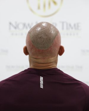 Thiago Alves Instagram - Last week, I traveled to Istanbul, Turkey, to get a hair transplant with my friends @now.hairtime. Before making the decision, I did a lot of research, and I am incredibly pleased with the experience.

The entire process was seamless. From pick-up to drop-off, the professionals at @now.hairtime went above and beyond my expectations. The transplant took about 8 hours and besides the anesthesia, it was completely painless.

Many people had told me that I looked good bald, but I wanted the option to have hair again. So, why not?

If you are considering getting a hair transplant, I highly recommend taking the trip and visiting my friends at @now.hairtime. Don't forget to mention the Pitbull sent you - you won't regret it.

Oss 

🇧🇷🇧🇷🇧🇷🇧🇷

Na semana passada, viajei para Istambul, na Turquia, para fazer um transplante capilar com meus amigos @now.hairtime. Antes de tomar a decisão, pesquisei bastante e estou extremamente satisfeito com a experiência.

Todo o processo foi perfeito. Da chegado até a saída, os profissionais da @now.hairtime superaram minhas expectativas. O transplante durou cerca de 8 horas e tirando a a anestesia foi totalmente indolor.

Muitas pessoas me disseram que eu parecia bem careca, mas eu queria a opção de ter cabelo novamente. Então por que não?

Se você está pensando em fazer um transplante capilar, recomendo fortemente que você faça uma viagem e visite meus amigos em @now.hairtime. Não se esqueça de mencionar o Pitbull que lhe enviou - você não se arrependerá.

#longhairdontcare #Pitbull #CoachPitbull #yourfavoritemmacoach #worldchampion #muaythaiwreckingmachine #itrainanywhere #livetrained #attarmy #mma #ufc #bellator #pfl #muaythai #wrestling #boxing #bjj #autismdad #autismawareness #wontstopuntiliwin #guns #livingthedream