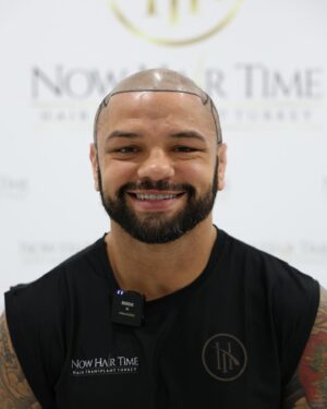 Thiago Alves Instagram - Last week, I traveled to Istanbul, Turkey, to get a hair transplant with my friends @now.hairtime. Before making the decision, I did a lot of research, and I am incredibly pleased with the experience.

The entire process was seamless. From pick-up to drop-off, the professionals at @now.hairtime went above and beyond my expectations. The transplant took about 8 hours and besides the anesthesia, it was completely painless.

Many people had told me that I looked good bald, but I wanted the option to have hair again. So, why not?

If you are considering getting a hair transplant, I highly recommend taking the trip and visiting my friends at @now.hairtime. Don't forget to mention the Pitbull sent you - you won't regret it.

Oss 

🇧🇷🇧🇷🇧🇷🇧🇷

Na semana passada, viajei para Istambul, na Turquia, para fazer um transplante capilar com meus amigos @now.hairtime. Antes de tomar a decisão, pesquisei bastante e estou extremamente satisfeito com a experiência.

Todo o processo foi perfeito. Da chegado até a saída, os profissionais da @now.hairtime superaram minhas expectativas. O transplante durou cerca de 8 horas e tirando a a anestesia foi totalmente indolor.

Muitas pessoas me disseram que eu parecia bem careca, mas eu queria a opção de ter cabelo novamente. Então por que não?

Se você está pensando em fazer um transplante capilar, recomendo fortemente que você faça uma viagem e visite meus amigos em @now.hairtime. Não se esqueça de mencionar o Pitbull que lhe enviou - você não se arrependerá.

#longhairdontcare #Pitbull #CoachPitbull #yourfavoritemmacoach #worldchampion #muaythaiwreckingmachine #itrainanywhere #livetrained #attarmy #mma #ufc #bellator #pfl #muaythai #wrestling #boxing #bjj #autismdad #autismawareness #wontstopuntiliwin #guns #livingthedream