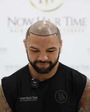 Thiago Alves Instagram - Last week, I traveled to Istanbul, Turkey, to get a hair transplant with my friends @now.hairtime. Before making the decision, I did a lot of research, and I am incredibly pleased with the experience.

The entire process was seamless. From pick-up to drop-off, the professionals at @now.hairtime went above and beyond my expectations. The transplant took about 8 hours and besides the anesthesia, it was completely painless.

Many people had told me that I looked good bald, but I wanted the option to have hair again. So, why not?

If you are considering getting a hair transplant, I highly recommend taking the trip and visiting my friends at @now.hairtime. Don't forget to mention the Pitbull sent you - you won't regret it.

Oss 

🇧🇷🇧🇷🇧🇷🇧🇷

Na semana passada, viajei para Istambul, na Turquia, para fazer um transplante capilar com meus amigos @now.hairtime. Antes de tomar a decisão, pesquisei bastante e estou extremamente satisfeito com a experiência.

Todo o processo foi perfeito. Da chegado até a saída, os profissionais da @now.hairtime superaram minhas expectativas. O transplante durou cerca de 8 horas e tirando a a anestesia foi totalmente indolor.

Muitas pessoas me disseram que eu parecia bem careca, mas eu queria a opção de ter cabelo novamente. Então por que não?

Se você está pensando em fazer um transplante capilar, recomendo fortemente que você faça uma viagem e visite meus amigos em @now.hairtime. Não se esqueça de mencionar o Pitbull que lhe enviou - você não se arrependerá.

#longhairdontcare #Pitbull #CoachPitbull #yourfavoritemmacoach #worldchampion #muaythaiwreckingmachine #itrainanywhere #livetrained #attarmy #mma #ufc #bellator #pfl #muaythai #wrestling #boxing #bjj #autismdad #autismawareness #wontstopuntiliwin #guns #livingthedream
