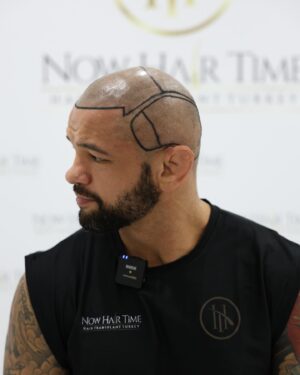 Thiago Alves Instagram - Last week, I traveled to Istanbul, Turkey, to get a hair transplant with my friends @now.hairtime. Before making the decision, I did a lot of research, and I am incredibly pleased with the experience.

The entire process was seamless. From pick-up to drop-off, the professionals at @now.hairtime went above and beyond my expectations. The transplant took about 8 hours and besides the anesthesia, it was completely painless.

Many people had told me that I looked good bald, but I wanted the option to have hair again. So, why not?

If you are considering getting a hair transplant, I highly recommend taking the trip and visiting my friends at @now.hairtime. Don't forget to mention the Pitbull sent you - you won't regret it.

Oss 

🇧🇷🇧🇷🇧🇷🇧🇷

Na semana passada, viajei para Istambul, na Turquia, para fazer um transplante capilar com meus amigos @now.hairtime. Antes de tomar a decisão, pesquisei bastante e estou extremamente satisfeito com a experiência.

Todo o processo foi perfeito. Da chegado até a saída, os profissionais da @now.hairtime superaram minhas expectativas. O transplante durou cerca de 8 horas e tirando a a anestesia foi totalmente indolor.

Muitas pessoas me disseram que eu parecia bem careca, mas eu queria a opção de ter cabelo novamente. Então por que não?

Se você está pensando em fazer um transplante capilar, recomendo fortemente que você faça uma viagem e visite meus amigos em @now.hairtime. Não se esqueça de mencionar o Pitbull que lhe enviou - você não se arrependerá.

#longhairdontcare #Pitbull #CoachPitbull #yourfavoritemmacoach #worldchampion #muaythaiwreckingmachine #itrainanywhere #livetrained #attarmy #mma #ufc #bellator #pfl #muaythai #wrestling #boxing #bjj #autismdad #autismawareness #wontstopuntiliwin #guns #livingthedream