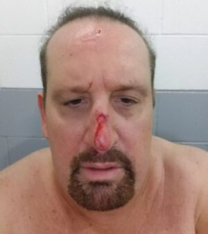 Tom Laughlin Instagram - 4th time broken nose
2 #ECW 
1 #wwe
1 indie
I ❤it