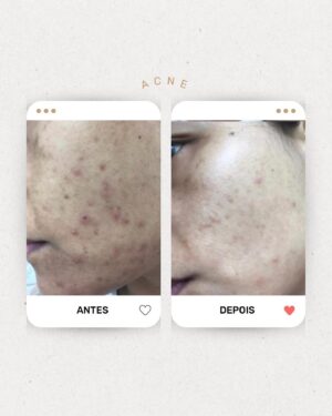 Vanessa Machado Instagram - Já sabemos que o Eight mudou a vida de milhares de pessoas. Nada mais justo que mostrar alguns desses depoimentos e fotos de antes/depois que recebemos das nossas clientes maravilhosas.

Arrasta pro lado >>>

#acne #melasma #oil #vanessamachado #pelemadura #cuidadoscomapele #oleosessenciais