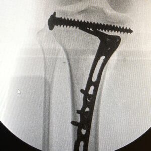 Yolanda Lynes Instagram - My leg snapped in half backwards, while sparring with a guy in BJJ. I broke the joint in 3 places. The rest is TBC.
Say hello to my new leg 🤖 
I hate retelling the story and reliving the moment again.
But after 16 days in hospital, I have spent the past month pretty much bed-bound, I have another month to go before I can start attempting to bear weight on it. 
I just want to say a huge thank you to all the hospital staff, my surgeons, doctors, nurses, everyone who has helped me along the way. 
And also thank you to everyone who has sent me well wishes, I love you all. 
I have documented and video’d my entire journey, daily, including the fight/sparring itself (which I might share with you all at some point) to see how far I’ve come. I’m looking forward to vlogging the happy ending where I’m back on my feet 🤞🏼 
I know I’m slow on replies, but at the moment my focus is just on recovery. 
Thank you everyone ❤️ xx