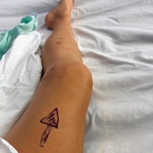 Yolanda Lynes Instagram - My leg snapped in half backwards, while sparring with a guy in BJJ. I broke the joint in 3 places. The rest is TBC.
Say hello to my new leg 🤖 
I hate retelling the story and reliving the moment again.
But after 16 days in hospital, I have spent the past month pretty much bed-bound, I have another month to go before I can start attempting to bear weight on it. 
I just want to say a huge thank you to all the hospital staff, my surgeons, doctors, nurses, everyone who has helped me along the way. 
And also thank you to everyone who has sent me well wishes, I love you all. 
I have documented and video’d my entire journey, daily, including the fight/sparring itself (which I might share with you all at some point) to see how far I’ve come. I’m looking forward to vlogging the happy ending where I’m back on my feet 🤞🏼 
I know I’m slow on replies, but at the moment my focus is just on recovery. 
Thank you everyone ❤️ xx