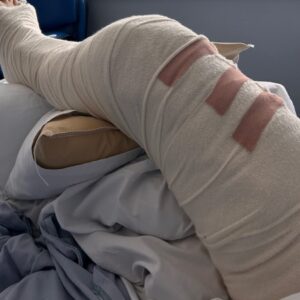 Yolanda Lynes Instagram - My leg snapped in half backwards, while sparring with a guy in BJJ. I broke the joint in 3 places. The rest is TBC.
Say hello to my new leg 🤖 
I hate retelling the story and reliving the moment again.
But after 16 days in hospital, I have spent the past month pretty much bed-bound, I have another month to go before I can start attempting to bear weight on it. 
I just want to say a huge thank you to all the hospital staff, my surgeons, doctors, nurses, everyone who has helped me along the way. 
And also thank you to everyone who has sent me well wishes, I love you all. 
I have documented and video’d my entire journey, daily, including the fight/sparring itself (which I might share with you all at some point) to see how far I’ve come. I’m looking forward to vlogging the happy ending where I’m back on my feet 🤞🏼 
I know I’m slow on replies, but at the moment my focus is just on recovery. 
Thank you everyone ❤️ xx