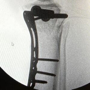 Yolanda Lynes Instagram - My leg snapped in half backwards, while sparring with a guy in BJJ. I broke the joint in 3 places. The rest is TBC.
Say hello to my new leg 🤖 
I hate retelling the story and reliving the moment again.
But after 16 days in hospital, I have spent the past month pretty much bed-bound, I have another month to go before I can start attempting to bear weight on it. 
I just want to say a huge thank you to all the hospital staff, my surgeons, doctors, nurses, everyone who has helped me along the way. 
And also thank you to everyone who has sent me well wishes, I love you all. 
I have documented and video’d my entire journey, daily, including the fight/sparring itself (which I might share with you all at some point) to see how far I’ve come. I’m looking forward to vlogging the happy ending where I’m back on my feet 🤞🏼 
I know I’m slow on replies, but at the moment my focus is just on recovery. 
Thank you everyone ❤️ xx