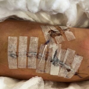 Yolanda Lynes Instagram - My leg snapped in half backwards, while sparring with a guy in BJJ. I broke the joint in 3 places. The rest is TBC.
Say hello to my new leg 🤖 
I hate retelling the story and reliving the moment again.
But after 16 days in hospital, I have spent the past month pretty much bed-bound, I have another month to go before I can start attempting to bear weight on it. 
I just want to say a huge thank you to all the hospital staff, my surgeons, doctors, nurses, everyone who has helped me along the way. 
And also thank you to everyone who has sent me well wishes, I love you all. 
I have documented and video’d my entire journey, daily, including the fight/sparring itself (which I might share with you all at some point) to see how far I’ve come. I’m looking forward to vlogging the happy ending where I’m back on my feet 🤞🏼 
I know I’m slow on replies, but at the moment my focus is just on recovery. 
Thank you everyone ❤️ xx