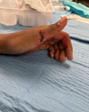 Zion Broadnax Instagram - Like @iamjamiefoxx told me in #dayshift snitches get stitches … well… I guess it true LOL. Side note the easiest way to get out of washing dishes with your parents , is to cut you hand washing a glass bowl. It was scary , but Feeling much better now. The video is the doctor showing how science works, the numbing shot sent a signal to my brain not to feel anything when he did the stitches. #zionbroadnax