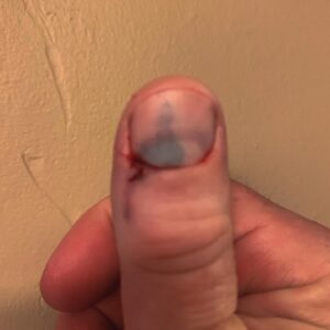 Barry Kerch Instagram - Sometimes dogs get in a fight.  Sometimes your thumb gets in the way. 🤦🏼‍♂️. 

#ouch #dogfight #campaignagainstnegativity #shinedown