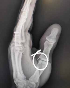 Bienve Aguado Alba Instagram - Thumbs up!! 👍🏼 Surgery went well.

Decided to get surgery to stabilize my thumb properly so I'm able to do crazy shit again and avoid future problems.

Thanks @dr_sergialabau and @icatme_ma 🙏🏼

I should be back in 3/4 weeks.