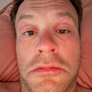 Christian Fuhlendorff Instagram - Lidt billeder fra ferien😂 p.s. Det har været en stående joke de sidste del år, at mine øjne har det med at hæve på ferien. Og denne, var ingen undertagelse! Plus jeg også fik en god omgang Denguefeber oveni. Perfekt ferie!