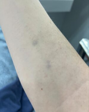 Colby Minifie Instagram - 🚨Spoilers!!!🚨what fun what fun it was to shoot this final episode of season 4, directed by @erickripke1. I screamed so hard when shooting up V I burst all the blood vessels under my eyes. And some track marks to prove it. The final pic is a mishap with the printer in the makeup trailer that produced my favorite pic of me of all time. Thanks Amber!! And a big thanks to @zeelowcee for this epic prosthetic ❤️❤️ big love to the whole crew