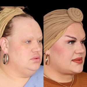 Eureka O'Hara Instagram - Check out @eurekaohara and her progress three month's post-op. Check back tomorrow to hear more about the procedure and what we did to achieve these results. What's our favorite response from her? She can breath better at night! The weight under chin has been lifted for her. 

We love Eureka and are so grateful she has picked us to be in charge of her care. Thank you for choosing Davis Facial Plastics!

⭐ Buccal Fat Removal
⭐ Upper Blepharoplasty
⭐ Platysmaplasty
⭐ Submental Liposuction

📞 (424) 284-3164
🌐 davisfacialplastics.com
📍 9440 Santa Monica Blvd Suite 708, Beverly Hills, CA 90210 
📷 These photos are used with explicit consent from the patient.

#eurekaohara #eureka #platysmaplasty #plasticsurgeon #plasticsurgery #beverlyhills #expert #buccalfatremoval