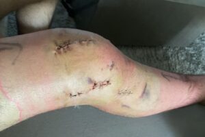 Ilias Bulaid Instagram - Het is pas over als je opgeeft, 9 maanden geleden liep @officialbulaid een zware knie blessure op in zijn laatste gevecht. Gelukkig konden we snel terecht bij de top orthopeed @rvdijck die een garantie is voor vakmanschap, empathie en snel schakelen. De gehele revalidatie hebben we als een team samen gedaan. In slechte tijden weet je wie er staan en wie er gaan.
 
Keihard werken was de basis en de grootste uitdaging was het geduld bewaren van @officialbulaid 
Ik was live bij de operatie en het eerste wat hij zei toen hij ontwaakte uit de narcose “ik moet vechten” deze zin herhaalde hij minimaal 300 keer en gelijk gingen alle monitoren op hol.
Hoe diep zit het? Hahahaha heel diep en dat is waar het om gaat als je grotere doelen hebt in het leven.

Het gevecht van afgelopen zaterdag was zo’n mooie bekroning van het proces. Ik heb nog nooit zo ontspannen zitten genieten hoe alle puzzelstukjes bij elkaar kwamen. Drie maal raden waar hij het gevecht mee openden? Een knetterharde lowkick op binnenkant been van zijn tegenstander. Dat was een fantastische bevestiging hoeveel vertrouwen hij weer had in zijn lichaam. 

Het was een waar genoegen samen te werken met dit echte team @duanemma @osszziee @rvdijck