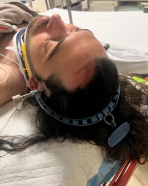 Jaimen Hudson Instagram - A week ago on my way to the beach I fell heavily out of my chair and have broken my neck for the second time. After spending the night in Esperance Hospital, I was flown to Royal Perth hospital by the Royal flying Dr Service.
Upon arriving in Perth, I had a traction system screwed into the side of my temples, and then a 4 1/2 kg weight hung off of the back to stabilise my neck.
I was in that system for approximately 2 1/2 days before going into surgery on Thursday to fuse my neck.
The surgery took about 6 1/2 hours and I’m so grateful to say it was successful. I have been very very, lucky not to lose any of the function that I had.
As you can imagine, this has been a very harrowing week for not only myself, but also my family.
I’ve been so incredibly lucky to have my beautiful wife, children, sister, mother, father as well as their partners by my side through the whole experience. 
Never once have they left me on my own. 
I also have such incredible friends that came and picked me up out of the dirt when I fell and took me to where the ambulance could collect me. Then a great group of friends that have also helped by supporting us through this week. It really means the world to me. 
All the nursing and medical staff have been incredible as well.
I will film a video and update you all in more detail at a later stage, but I just wanted to let you know I am okay and heading in the right direction.
You can break my stride, but never my spirit xx. I’ll be back doing all the fun shit I love to do and sharing it with you all again soon.
Love you all, Jaimen