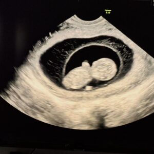 Karol Cariola Instagram - Hoy quiero compartir con ustedes una noticia que junto a Tomás nos tiene muy felices. 

Estoy embarazada ❤️, han sido casi 3 meses de bastantes síntomas, de cambios en mi cuerpo y sensaciones nuevas. Por supuesto es una decisión consciente. Estamos muy contentos y agradecidos de poder vivir juntos esta experiencia. 

Seré madre por primera vez. No voy a negarles que me siento diferente y que es uno de los desafíos más grandes a los que me he enfrentado en mi vida. Me da un poco de miedo, de nervios, pero sé que con el apoyo de Tomás (que será padre por tercera vez), podremos cuidarnos y vivir junto a sus hermanitos este bonito y deseado proceso.

Les agradezco y me alegra hacerles parte de esta noticia que nos tiene entusiasmados y muy felices 🐣