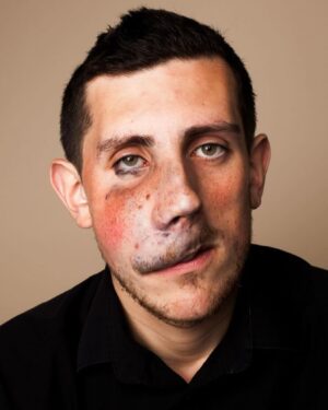 Katie Piper Instagram - Todays #MindsetMonday comes from @vmrory1993, he says “I’m Rory, I’m 30, and I was born with a birthmark called a venous malformation on my upper lip and right cheek, which I had around 20 operations on when I was younger to reduce the size of it.

Growing up I had to endure a great deal of prejudice and mental abuse which by the time I had reached my teenage years had completely shattered my confidence. I was very shy and felt like I was living a never ending nightmare.

People told me that I was ugly. People told me that they would kill themselves if they looked like me. People told me I would never achieve certain things in life, and because my confidence was so low I started to believe them.

I have now achieved everything that people told me that I wouldn’t, and more. With strength and positivity I have completely overcome the adversity I’ve faced in the past, and I want to show everyone that you can get through any low points that you might experience in your lifetime.

At one point I thought I was always going to be unhappy and shy, but here I am now happier and more confident than I ever thought I would be.I have even turned down the opportunity for further surgery to make my face ‘symmetrical’ because I am happy the way that I am.

Prejudice is a horrible thing, and nobody should ever be judged or subjected to abuse purely because of what they look like, their race, their sexuality or any other reason. There are people who have been killed due to prejudice, there are people who end their own lives due to prejudice.

There are people who aren’t comfortable in their own skin, all because of the prejudice that they have to face which is absolutely heart breaking. We live in a very multi cultural and diverse planet - and nobody should be made to feel like they don’t belong here.

Diversity is a beautiful thing, which should be celebrated and I am determined to continue do my best to help and inspire others. Never judge a book by its cover.”