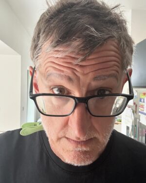 Louis Theroux Instagram - Not only is my Alopecia maybe slightly improving - I have also found a solution to the problem of neck wrinkles. See if you can guess what it is!!! In picture four I’ve shared a glimpse of one of my Alopecia patches - at the front of my scalp. The medical term is lesions. Not gonna lie - the goth in me is slightly enjoying the sudden appearance of patches and stripes of grey and white hair in my barnet. Google “Marie Antoinette Syndrome” for more on the lineage of this.