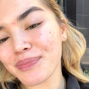 Paris Berelc Instagram - It’s been a journey… as @sarahfordofficial always says, “skin is within.” The past year I have had such a battle with acne… I felt embarrassed to take photos because of the way my skin looked. It can be incredibly frustrating especially when you’re not sure what’s causing it and everything you’re trying isn’t working. With switching birth control, reducing alcohol, eating healthy, and figuring out the right skin routine for me, I finally have a control over my acne. It just takes time babes 🪽