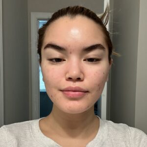 Paris Berelc Instagram - It’s been a journey… as @sarahfordofficial always says, “skin is within.” The past year I have had such a battle with acne… I felt embarrassed to take photos because of the way my skin looked. It can be incredibly frustrating especially when you’re not sure what’s causing it and everything you’re trying isn’t working. With switching birth control, reducing alcohol, eating healthy, and figuring out the right skin routine for me, I finally have a control over my acne. It just takes time babes 🪽