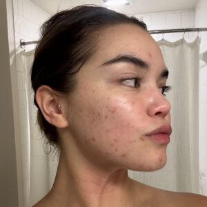 Paris Berelc Instagram - It’s been a journey… as @sarahfordofficial always says, “skin is within.” The past year I have had such a battle with acne… I felt embarrassed to take photos because of the way my skin looked. It can be incredibly frustrating especially when you’re not sure what’s causing it and everything you’re trying isn’t working. With switching birth control, reducing alcohol, eating healthy, and figuring out the right skin routine for me, I finally have a control over my acne. It just takes time babes 🪽