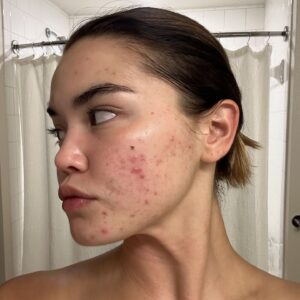 Paris Berelc Instagram - It’s been a journey… as @sarahfordofficial always says, “skin is within.” The past year I have had such a battle with acne… I felt embarrassed to take photos because of the way my skin looked. It can be incredibly frustrating especially when you’re not sure what’s causing it and everything you’re trying isn’t working. With switching birth control, reducing alcohol, eating healthy, and figuring out the right skin routine for me, I finally have a control over my acne. It just takes time babes 🪽