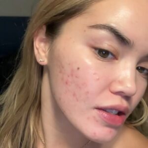 Paris Berelc Instagram - It’s been a journey… as @sarahfordofficial always says, “skin is within.” The past year I have had such a battle with acne… I felt embarrassed to take photos because of the way my skin looked. It can be incredibly frustrating especially when you’re not sure what’s causing it and everything you’re trying isn’t working. With switching birth control, reducing alcohol, eating healthy, and figuring out the right skin routine for me, I finally have a control over my acne. It just takes time babes 🪽