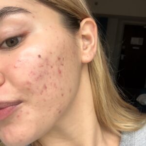 Paris Berelc Instagram - It’s been a journey… as @sarahfordofficial always says, “skin is within.” The past year I have had such a battle with acne… I felt embarrassed to take photos because of the way my skin looked. It can be incredibly frustrating especially when you’re not sure what’s causing it and everything you’re trying isn’t working. With switching birth control, reducing alcohol, eating healthy, and figuring out the right skin routine for me, I finally have a control over my acne. It just takes time babes 🪽