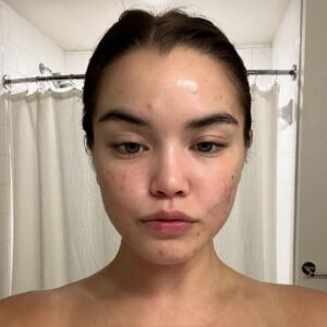 Paris Berelc Instagram - It’s been a journey… as @sarahfordofficial always says, “skin is within.” The past year I have had such a battle with acne… I felt embarrassed to take photos because of the way my skin looked. It can be incredibly frustrating especially when you’re not sure what’s causing it and everything you’re trying isn’t working. With switching birth control, reducing alcohol, eating healthy, and figuring out the right skin routine for me, I finally have a control over my acne. It just takes time babes 🪽