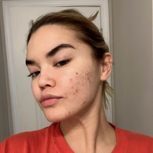 Paris Berelc Instagram - It’s been a journey… as @sarahfordofficial always says, “skin is within.” The past year I have had such a battle with acne… I felt embarrassed to take photos because of the way my skin looked. It can be incredibly frustrating especially when you’re not sure what’s causing it and everything you’re trying isn’t working. With switching birth control, reducing alcohol, eating healthy, and figuring out the right skin routine for me, I finally have a control over my acne. It just takes time babes 🪽