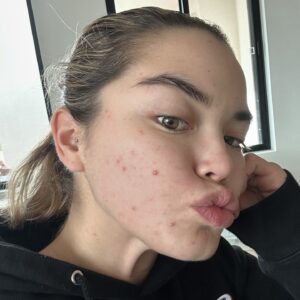 Paris Berelc Instagram - It’s been a journey… as @sarahfordofficial always says, “skin is within.” The past year I have had such a battle with acne… I felt embarrassed to take photos because of the way my skin looked. It can be incredibly frustrating especially when you’re not sure what’s causing it and everything you’re trying isn’t working. With switching birth control, reducing alcohol, eating healthy, and figuring out the right skin routine for me, I finally have a control over my acne. It just takes time babes 🪽