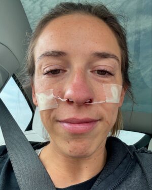 Rachel Ballinger Instagram - The stages of my nose surgery over the last 3 days. Y’all it was a JOURNEY! But we are over the biggest hump and easy breathing is in the near future! 😇☺️