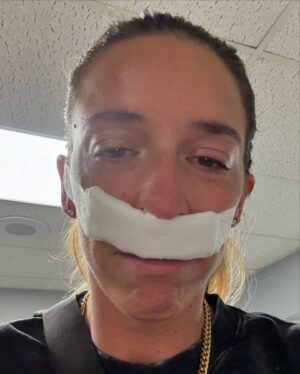 Rachel Ballinger Instagram - The stages of my nose surgery over the last 3 days. Y’all it was a JOURNEY! But we are over the biggest hump and easy breathing is in the near future! 😇☺️