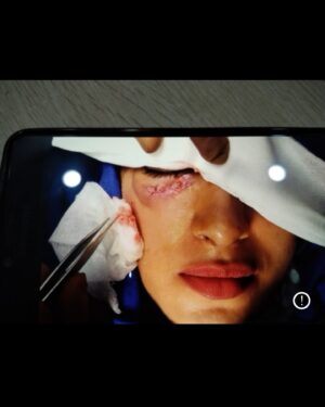 Reena Aggarwal Instagram - In 2018 I met with an accident on the set of a tv show that I was doing. Till date I get Dms why I left that show abruptly and why I never made it back on the show. So today I decided to share this story with all of you. I was shooting with a dog and it happened to bite me right under my eye. I still get flashes of that incident it was bizarre. I wasn’t used to seeing my face like that I was losing a lot of work because of that. The same year, before my wound could heal completely, I also lost my father within a month of that incident. Losing my father was a deeper scar than the one I had on my face. And to top it up, while I still hadn’t recovered from the pain of losing him my personal life also started falling apart . I started to feel that I am going to lose everything.. I started feeling scared, insecure and anxious that I will lose my mom,my family I was literally living in fear coz everything was just being taken away from me… I was only left with my trauma. 

•Why I’m sharing it today?? Coz I feel an actor is misunderstood so easily and people think all actors are privileged. But we are also normal human beings and as humans we also experience all kinds of hardships and we still keep our mouth shut and most of the time don’t share our sad stories openly coz even after all the s**t we experience, we still have to show up like soldiers. We still have to fight our battles silently. We still have to give our flesh and blood to our work. We still have to be loyal to a profession which is so ruthless. We still have to entertain you, make y’all laugh. 
•I was running away from my pain for a couple years and not fully accepting what was happening to me but eventually I had to. Once I accepted the reality I used my pain as the fire in me. I worked hard on myself to come out of darkness. Life of an artist is uncertain… We are mad people! And that’s the beauty of living for art. It can numb the pain at least if it can’t save you!!! I hope together we can make this world a kinder place to coexist and learn from each other’s lives!
P.s I still love dogs 🐕 ❤️

#artist #actorslife #throwbackthursday #potd #lifelessons #actors #journey #life #gratitude