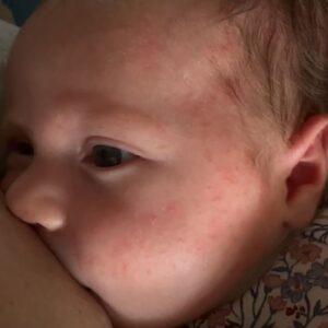 Sofia Arruda Instagram - A nossa Nenuca faz alergia à proteína do leite de vaca- APLV. Nunca pensei em tal coisa, porque ela mama em exclusivo e nunca lhe dei leite nenhum além do meu. Mas logo após fazer 1 mês ela começou a ficar com borbulhinhas no rosto que ficaram piores a cada dia que passava e bolsava muito ( de jato e às vezes leite da mamada anterior do género requeijão) . Eu pensei “tem refluxo e a pele está a habituar-se ao meio extra uterino”, mas não, a Dra. Joana Appleton que é também pediatra do Xavier, disse-me para deixar de comer alimentos com proteína de leite de vaca. Eu pensei que era alergia à lactose mas não, é tudo o que tem proteína de leite de vaca e é a mãe que tem de deixar de comer porque passa para o leite materno. Ou seja, não basta comer iogurtes/leite/queijo sem lactose, temos mesmo de passar para as opções vegetais. (também convém evitar a soja) 
No nosso caso, depois de fazer esta alteração alimentar, em 4 dias ela melhorou imenso ! Hoje não tem nada no rosto e bolsa muito muito raramente. 🙌🏼 
Os sintomas podem incluir também diarreia, inchaço nos olhos, dificuldade em dormir, dificuldade em respirar… 

Sei que há recentes mamãs por aqui e quis deixar o meu testemunho porque pode ajudar os vossos bebés. ( a primeira fotografia é agora, as outras e os vídeos  são de quando ainda não tínhamos identificado o problema)

Espero ajudar ❤️🙌🏼